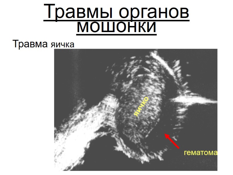 Травмы органов мошонки Травма яичка яичко гематома